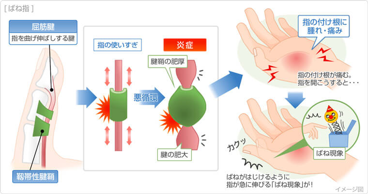 腱鞘炎の説明図