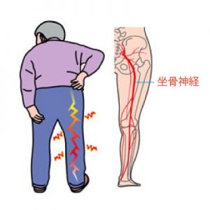 坐骨神経痛
